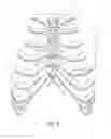 Fig. 05 - System for longitudinal closure of dissected sternums
