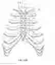 Fig. 11 - System for longitudinal closure of dissected sternums