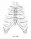 Fig. 12 - System for longitudinal closure of dissected sternums