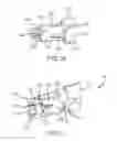 Fig. 10 - Ablation catheter designs and methods with enhanced diagnostic capabilities
