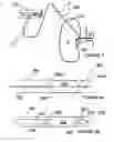 Fig. 04 - Methods for bilateral renal neuromodulation