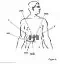 Fig. 11 - Methods for bilateral renal neuromodulation