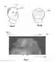 Fig. 03 - Systems and methods for planning hair transplantation