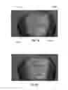 Fig. 11 - Systems and methods for planning hair transplantation