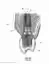 Fig. 04 - Restoration dental implant system and method
