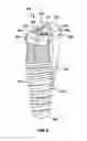 Fig. 11 - Restoration dental implant system and method