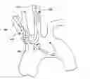 Fig. 01 - Aortic embolic protection device