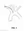 Fig. 02 - Aortic embolic protection device