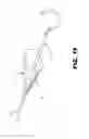 Fig. 07 - Aortic embolic protection device