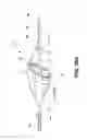 Fig. 32 - Aortic embolic protection device
