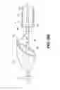 Fig. 34 - Aortic embolic protection device