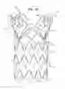 Fig. 06 - ASCENDING AORTA STENT-GRAFT SYSTEM