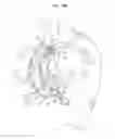Fig. 19 - ASCENDING AORTA STENT-GRAFT SYSTEM
