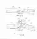Fig. 13 - Device for rapid repair of body conduits