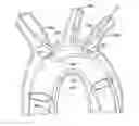 Fig. 01 - Branched stent graft device and deployment