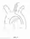 Fig. 04 - Branched stent graft device and deployment