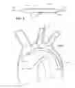 Fig. 05 - Branched stent graft device and deployment