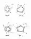 Fig. 03 - Method and apparatus useful for transcatheter aortic valve implantation