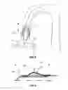 Fig. 05 - Method and apparatus useful for transcatheter aortic valve implantation