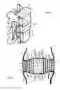 Fig. 02 - Method for relieving back/neck pain and repairing intervertebral disc