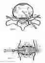 Fig. 07 - Method for relieving back/neck pain and repairing intervertebral disc