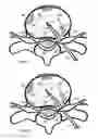 Fig. 08 - Method for relieving back/neck pain and repairing intervertebral disc