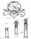 Fig. 10 - Method for relieving back/neck pain and repairing intervertebral disc