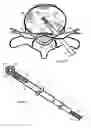 Fig. 11 - Method for relieving back/neck pain and repairing intervertebral disc