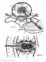 Fig. 17 - Method for relieving back/neck pain and repairing intervertebral disc