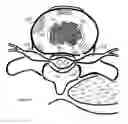 Fig. 19 - Method for relieving back/neck pain and repairing intervertebral disc