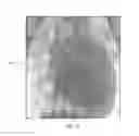 Fig. 04 - INTRALUMINAL IMPLANTS AND METHODS