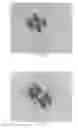 Fig. 18 - INTRALUMINAL IMPLANTS AND METHODS