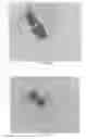 Fig. 22 - INTRALUMINAL IMPLANTS AND METHODS