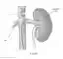 Fig. 46 - INTRALUMINAL IMPLANTS AND METHODS