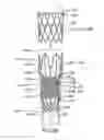 Fig. 07 - Devices and methods for gastrointestinal bypass