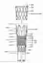 Fig. 07 - Devices and methods for gastrointestinal bypass