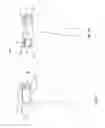 Fig. 05 - Orthopedic device for treating complications of the hip