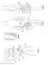 Fig. 19 - Orthopedic device for treating complications of the hip
