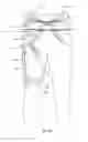 Fig. 29 - Orthopedic device for treating complications of the hip