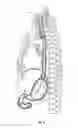 Fig. 03 - Apparatus and Method Of Gastric Cooling Using Balloon Catheter