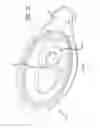 Fig. 14 - Pre-loaded injector for use with intraocular lens