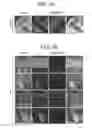 Fig. 02 - METHODS FOR TREATMENT OF MICROCEPHALY ASSOCIATED AUTISM DISORDERS