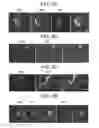 Fig. 03 - METHODS FOR TREATMENT OF MICROCEPHALY ASSOCIATED AUTISM DISORDERS