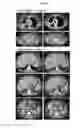 Fig. 20 - Dosages of immunoconjugates of antibodies and SN-38 for improved efficacy and decreased toxicity