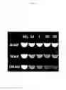 Fig. 03 - SILICONE-BASED ENTERIC CT CONTRAST MATERIAL