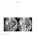 Fig. 05 - SILICONE-BASED ENTERIC CT CONTRAST MATERIAL