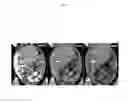 Fig. 06 - SILICONE-BASED ENTERIC CT CONTRAST MATERIAL