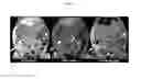 Fig. 07 - SILICONE-BASED ENTERIC CT CONTRAST MATERIAL