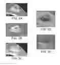 Fig. 04 - Implants and biodegradable tissue markers