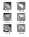 Fig. 05 - Implants and biodegradable tissue markers